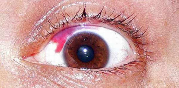 фото крови на белке глаза